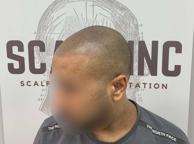 tm3recededhairline tm3recededhairline