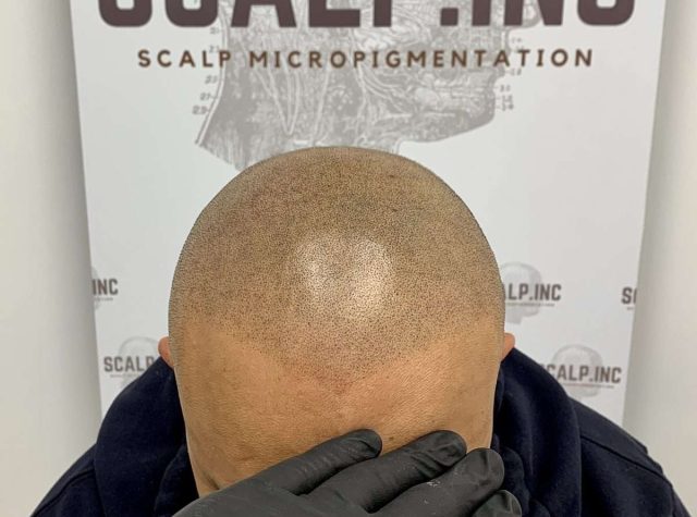 tm3typeofhairlineswidowspeak tm3typeofhairlineswidowspeak