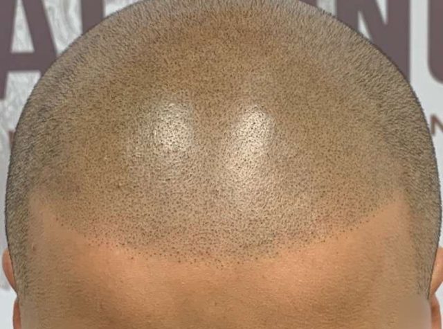 tm3typesofhairlinebroken_jaggered tm3typesofhairlinebroken_jaggered